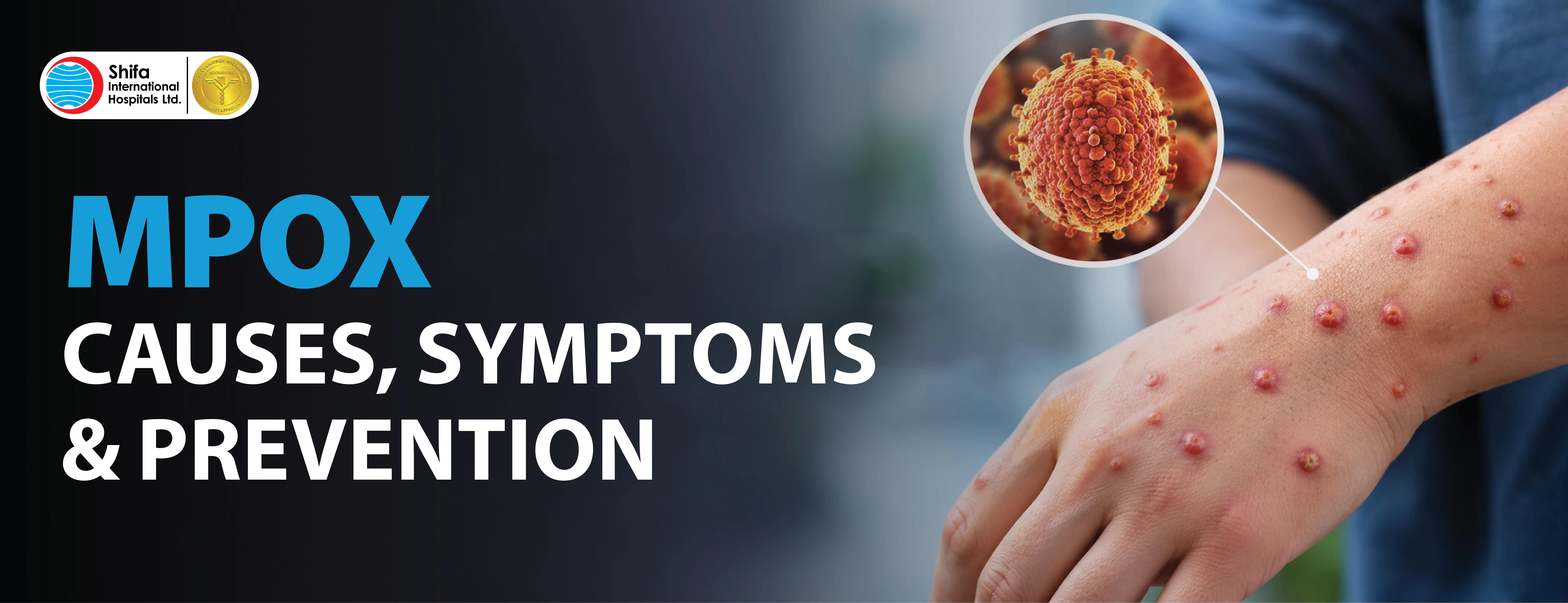 Monkeypox Symptoms, Causes & Prevention Guide
